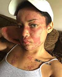 It is characterized by a wide spectrum of clinical symptoms and immune serological parameters, with variable evolution and prognosis. This Black Woman Is Sharing Images Of Her Lupus Flare Ups To Raise Awareness Of The Disease Bglh Marketplace