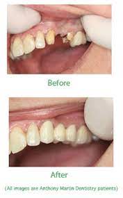 Dental Bridges To Fix Missing Teeth Or Gaps Dental Bridge Cosmetic Dentistry Dental Cosmetics