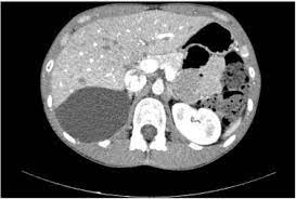 A laparotomy was performed to avoid rupturing the cyst due to the suspicion of the cystic mass being an appendiceal mucocele. Laparoscopic Treatment Of Retroperitoneal Cystic Mesothelioma Two Cases Reported Sciencedirect