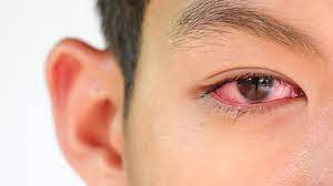Check spelling or type a new query. Apa Benar Mata Merah Pertanda Gejala Virus Corona Ini Faktanya
