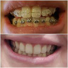 Getting your braces off is a little bit like getting them on. I Got My Braces Off After 3 Years Braces