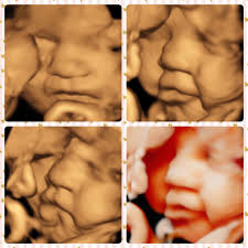 See Who's Kickin 3D/4D Ultrasound