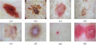 Almost all basal and squamous cell cancers and the vast majority of melan. Artificial Intelligence Based Image Classification Methods For Diagnosis Of Skin Cancer Challenges And Opportunities Sciencedirect