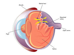Image result for Retinal Detachment