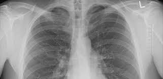 Daca totusi un agent iritant resuseste sa patrunda in plamani, acesta se va bolca in stratul fin de mucus care tapeteaza caile respiratorii. Apa La Plamani Pleurezia Ce Boli Poate Ascunde Cancer360