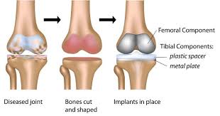 Total Cost Of Partialkneereplacementsurgeryinindia Success Rate Statistics Outcomes Knee Arthroplasty Total Knee Replacement Knee Replacement Surgery