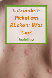 Im gesicht, nacken, auf der brust (dekolleté), am rücken Entzundete Pickel Am Rucken Was Tun Pickel Was Tun Gegen Pickel Pickel Entfernung