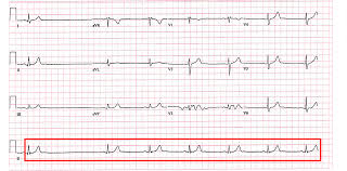 Image result for Lyme Carditis