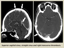Hanprasertpong t., hanprasertpong j., riabroi k. Cavernous Sinus Thrombosis Ct Scan Ct Scan Machine
