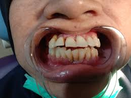 We did not find results for: Pengalaman Buruk Pasang Behel Kawat Gigi Sembarangan