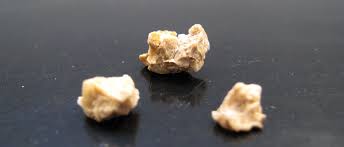 What Kidney Stones Are Kidney Stone Evaluation And Treatment Program