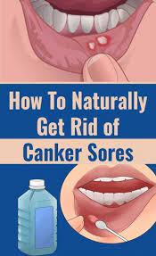 Home Remedies For Canker Sore On Tongue Canker Sore Ulcer Remedies Mouth Sore In Mouth Remedies