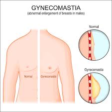 Image result for Gynecomastia