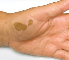 What are these orange stains that have appeared on my hands overnight? Two Brown Spots On The Left Hand Page 2 Of 2 Dermatology Grand Rounds