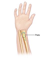 Hi london, well, i'm gonna say that i never do this! Treating Wrist Fractures Saint Luke S Health System