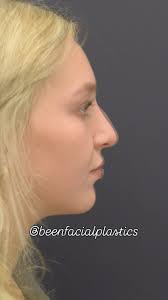 amazing transformation! Rhinoplasty by Dr. Mark Been., ., .#facelift  #faceliftsurgery #faceliftbeforeandafter #plasticsurgerybeforeandafter  #plasticsurgeryresults #beforeandafterplasticsurgery ...