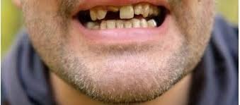 But if the tooth decay process continues, more minerals are lost. What To Do With Rotten Teeth Clover Smile Studio Blog