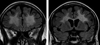 Image result for AIDS Dementia Complex