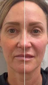 Subtle. Soft. Stunning. ✨ Tox refresh + ½ syringe Juvéderm Ultra XC =  chef's kiss 💉 #SquareOneAesthetics #TallahasseeFL #TallyAesthetics  #AestheticInjector #MedSpaMagic #JuvédermUltraXC #NaturalAesthetics  #FillerResults #LipFiller #BeautyTok #GlowUp ...