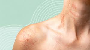 Image result for sweat rash on back