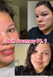 Pt. 1 Skin Journey. I waited to post this so I could feel the product out  and so far it feels great