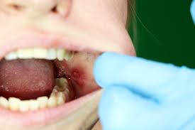 Als zahn ziehen bezeichnet man das entfernen eines zahnes (zahnextraktion, exodontie) ohne lesen sie hier alles wichtige über das zahn ziehen, wann man es durchführt und welche risiken. Wie Lange Dauert Die Wundheilung Nach Zahnextraktion