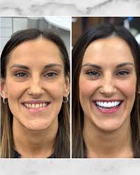 For all the millions of fans waiting, Lorelei finally got her braces on.  See her video to the left to follow her journey. #braces #smile #kids  #bully #sweet #love #fun #transformation #dentist #