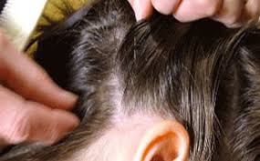 طرق التخلص من القمل نهائيا للصغار والكبار الوطنية للإعلام