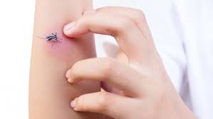 Din fericire, pentru majoritatea copiilor, nu este unul reacţiile apar de obicei imediat după înţepătură, dar pot să apară şi după circa 60 de minute. Intepatura De Albina Reactii Adverse Despre ViaÈ›a Din Romania