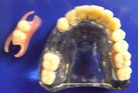 En revanche, si vous avez une prothèse dentaire amovible partielle (qui ne remplace qu'une ou plusieurs dents), il y a une petite technique à au début, vous vous exercerez devant un miroir et, rapidement, le mouvement deviendra intuitif. Comment Vivre Avec Une Prothese Mobile Conseil Dentaire Dr Hauteville