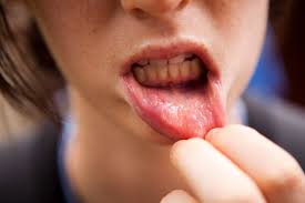 Mouth blood blister inside cheek. Canker Sores Symptoms Causes Treatments