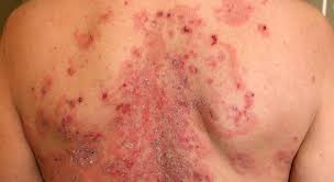 Image result for Pemphigus