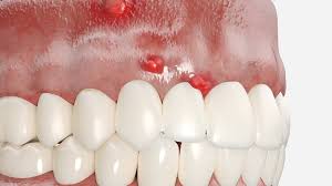 Image result for Periodontal Abscess