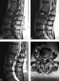Image result for Psoas Sign