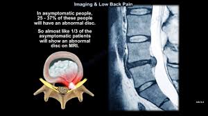 Image result for Low Back Imaging