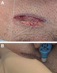 A groin injury will really mess up your running schedule for a long time. Mini Open Incision Sports Hernia Repair A Surgical Technique For Core Muscle Injury Sciencedirect
