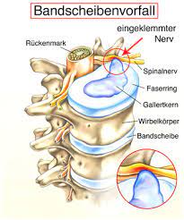 Bandscheibenvorfall Ursachen Symptome Behandlung