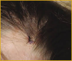 I had thick, natural curly, wavy hair when i was young. Scalp Biopsy Technique For The Hair Surgeon Hair Transplant Forum International