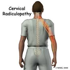 Pin By Aimee Anderson On Common Chiropractic Conditions Cervical Radiculopathy Pinched Nerve In Neck Pinched Nerve