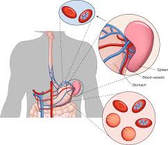 Frequently asked questions about malaria, disease, transmission, symptoms, diagnosis, treatment, complications with pregnancy, prevention, eradication and endemic areas. Malaria Parasites Hide In Plain Sight In The Dry Season Nature Medicine