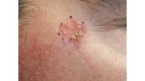 What does skin cancer look like? What Are The Symptoms Of Non Melanoma Skin Cancer