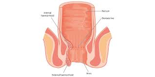 Die lage der klumpen bestimmt, ob die hämorrhoide eine externe oder interne ist. Fussen Aktuell Hamorrhoiden