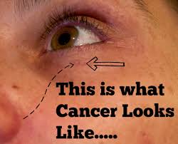 As skin cancer is an abnormal growth of cells in the skin, getting to know your skin is important to catch any skin changes early. What Does Skin Cancer Look Like Basal Cell Carcinoma