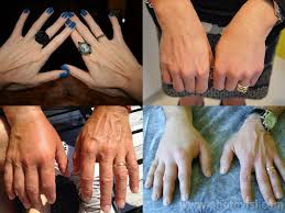 خلطة مدهلة لتسمين اليدين واخفاء العروق بسرعة رهيبة وإلى الأبد Health And Beauty Hands Beauty