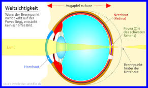 Weitsichtigkeit Ubersichtigkeit Hyperopie