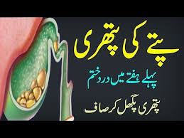Gallstone Treatment Without Surgery Pittay Ki Pathri Ki Ilaj In Hindi Urdu Youtube Gallstones Health Knowledge Herbal Treatment