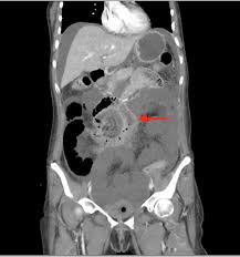 Image result for Midgut Volvulus