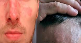 Vücutta normalden fazla oluşan kepeklenme ve sonrasında dökülmesiyle oluşan kızarıklık ilk belirtileridir. Seboreik Dermatit Nedir Karamandan Com Karaman Haber