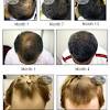 Find details of companies supplying finasteride, manufacturing & wholesaling finasterides in india. 1