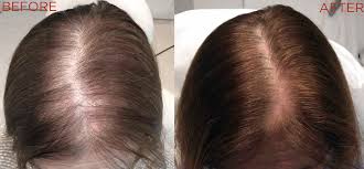 Hair loss occurs in approximately 35 million men and 21 million women. Platelet Rich Plasma Prp Therapy Unionderm The Art Science Of Skin